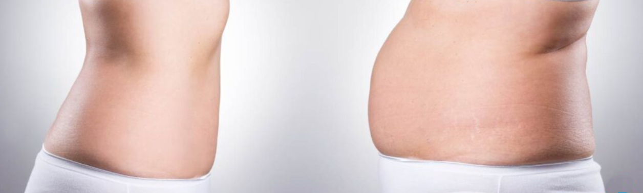 jak-wygląda-zatrzymanie-wody-w-organizmie