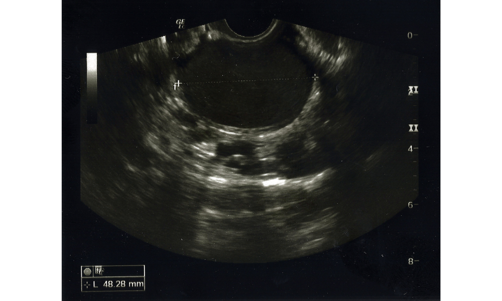 torbiel-endometrialna