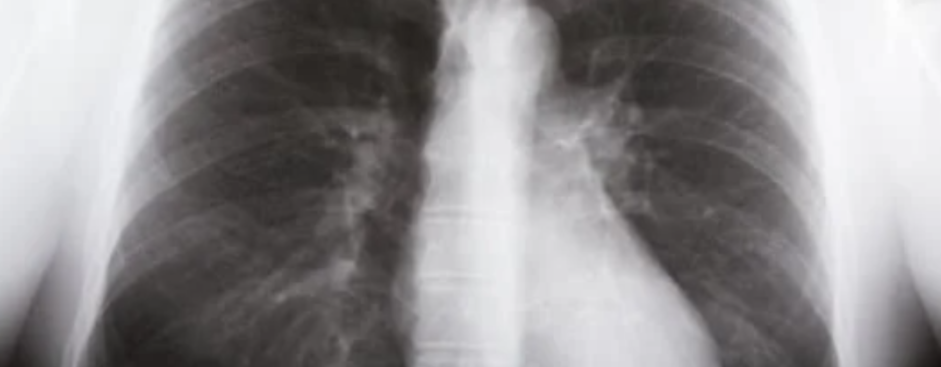 Nebuliazator NebuCare Max w walce z chorobami układu oddechowego