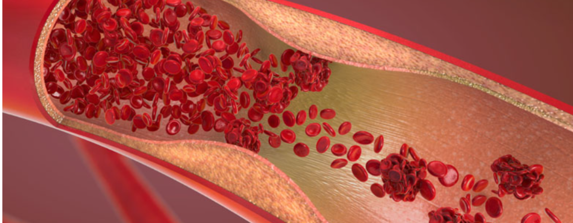 LipiForma Bergamia - zawalcz o prawidłowy cholesterol