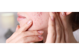 Walka z trądzikiem u dorosłych: Skuteczne strategie i najnowsze metody leczenia