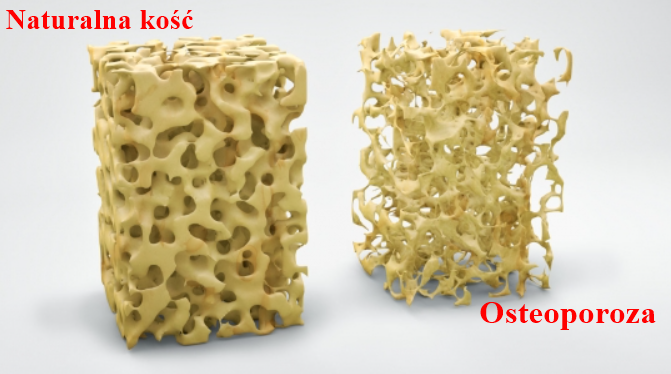 zdrowe-kości-a-osteoporoza