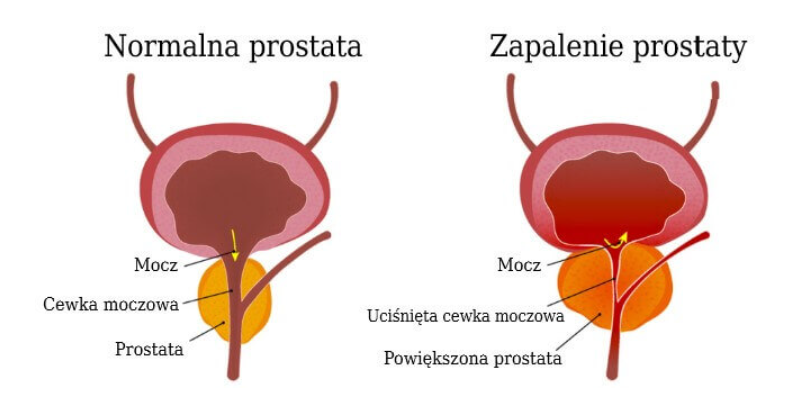 normalna-prostata-zapalenie-prostaty